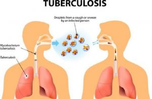 OMS: kazu tuberkoluze hahú menus iha Timor-Leste