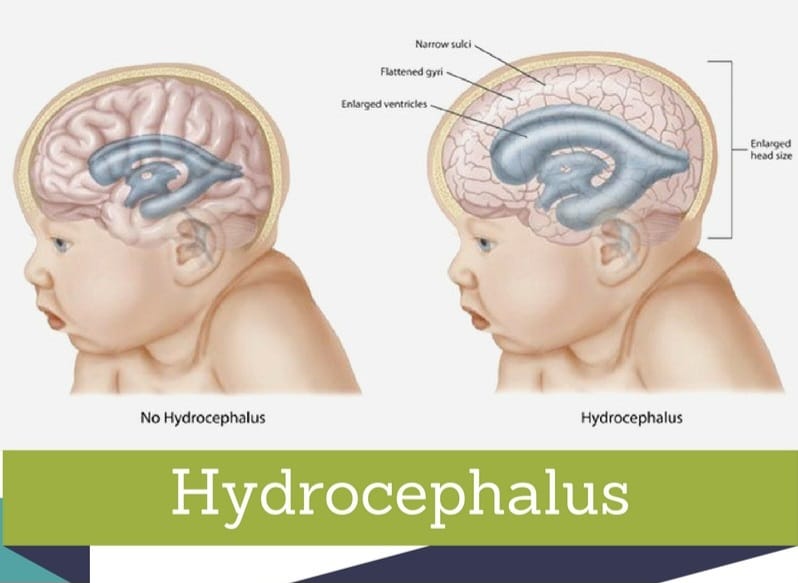 Bebé feto ho moras Hidrosefalus nafatin halo tratamentu konservativu iha HNGV