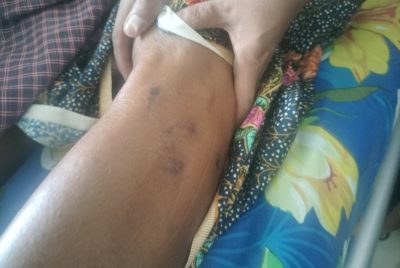 Sidadaun EX husi Gariuai suspeita kontaminadu raiva